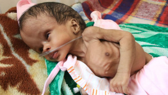 Yemeni child starving - Ahmad algohbary